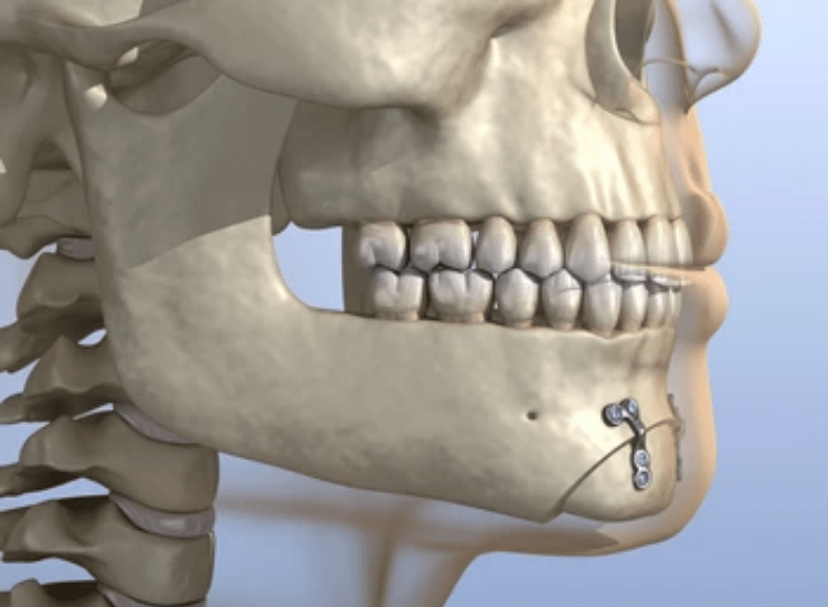 Best-Chin-Surgeon-in-Mumbai-dr-Tofiq-bohra-min-1