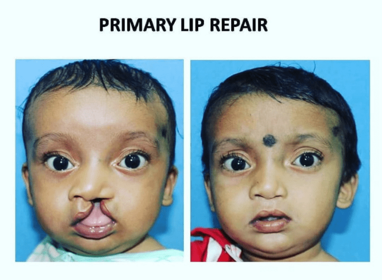 Best-Cleft-Surgeries-in-Mumbai-dr-Tofiq-bohra-1-min
