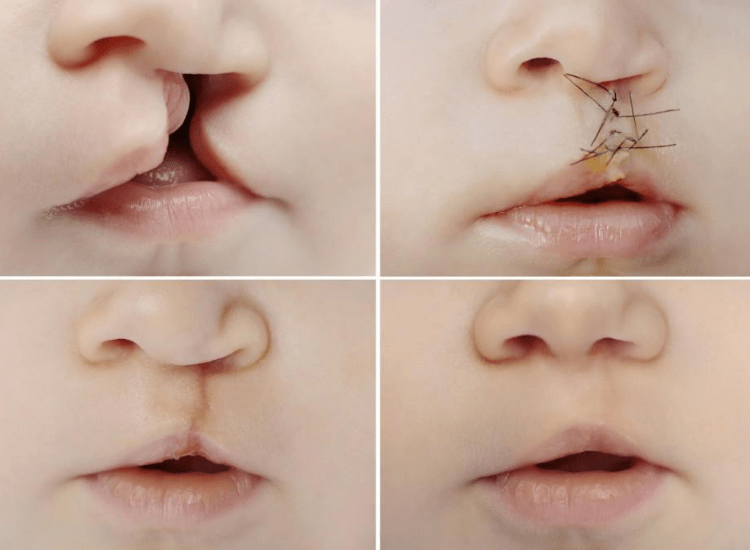 Best-Cleft-Surgeries-in-Mumbai-dr-Tofiq-bohra-3-min