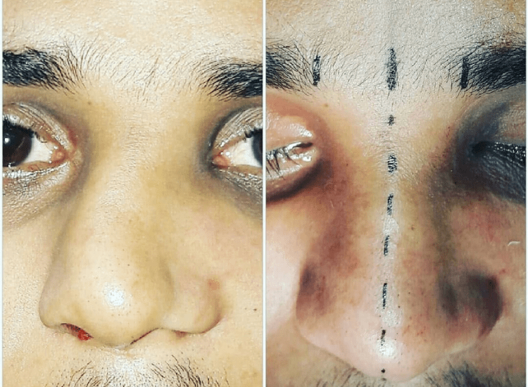 dr-Tofiq-bohra-Best-Nose-Surgeon-in-Mumbai-5-min