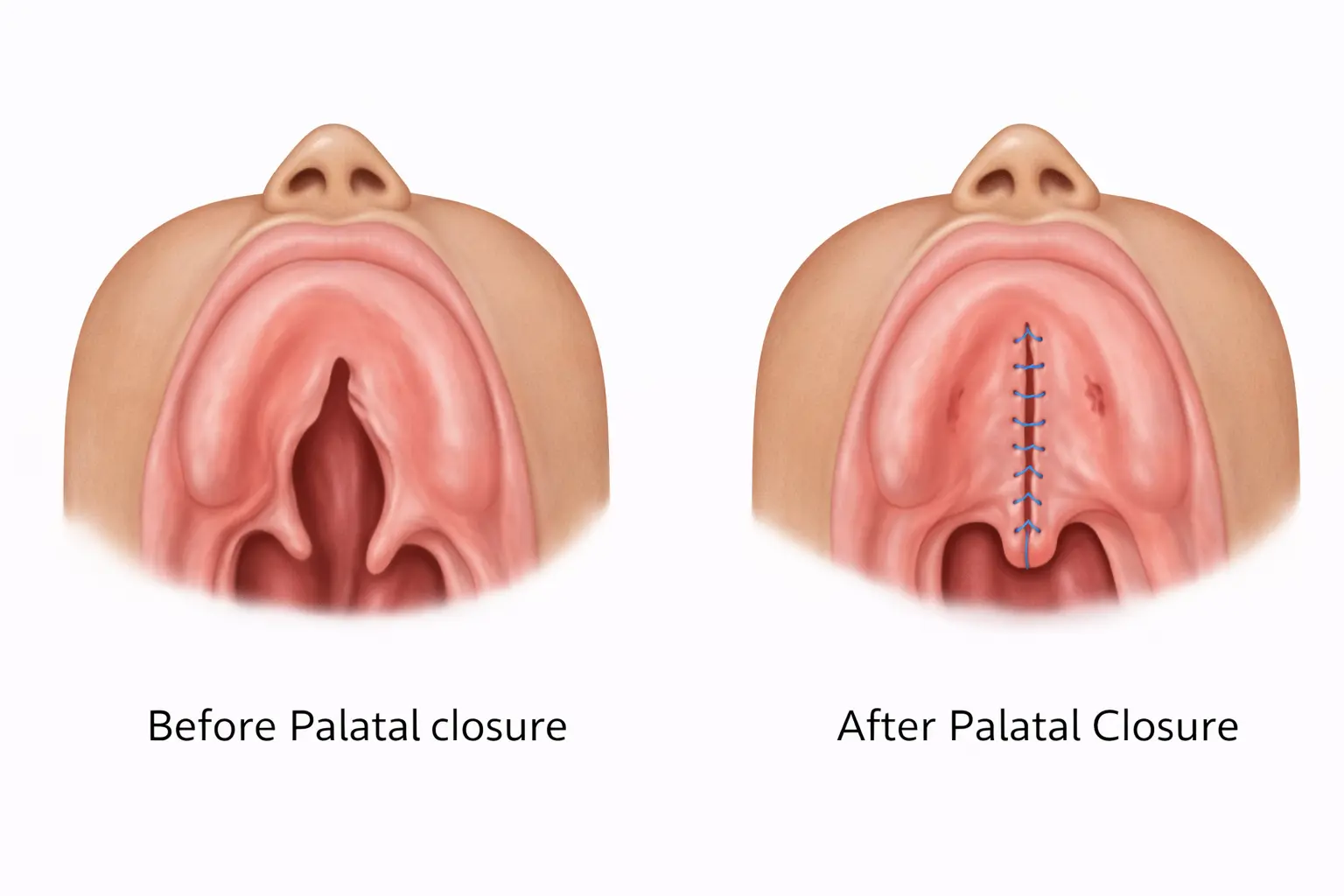 cleft palate surgery​ in Mumabi